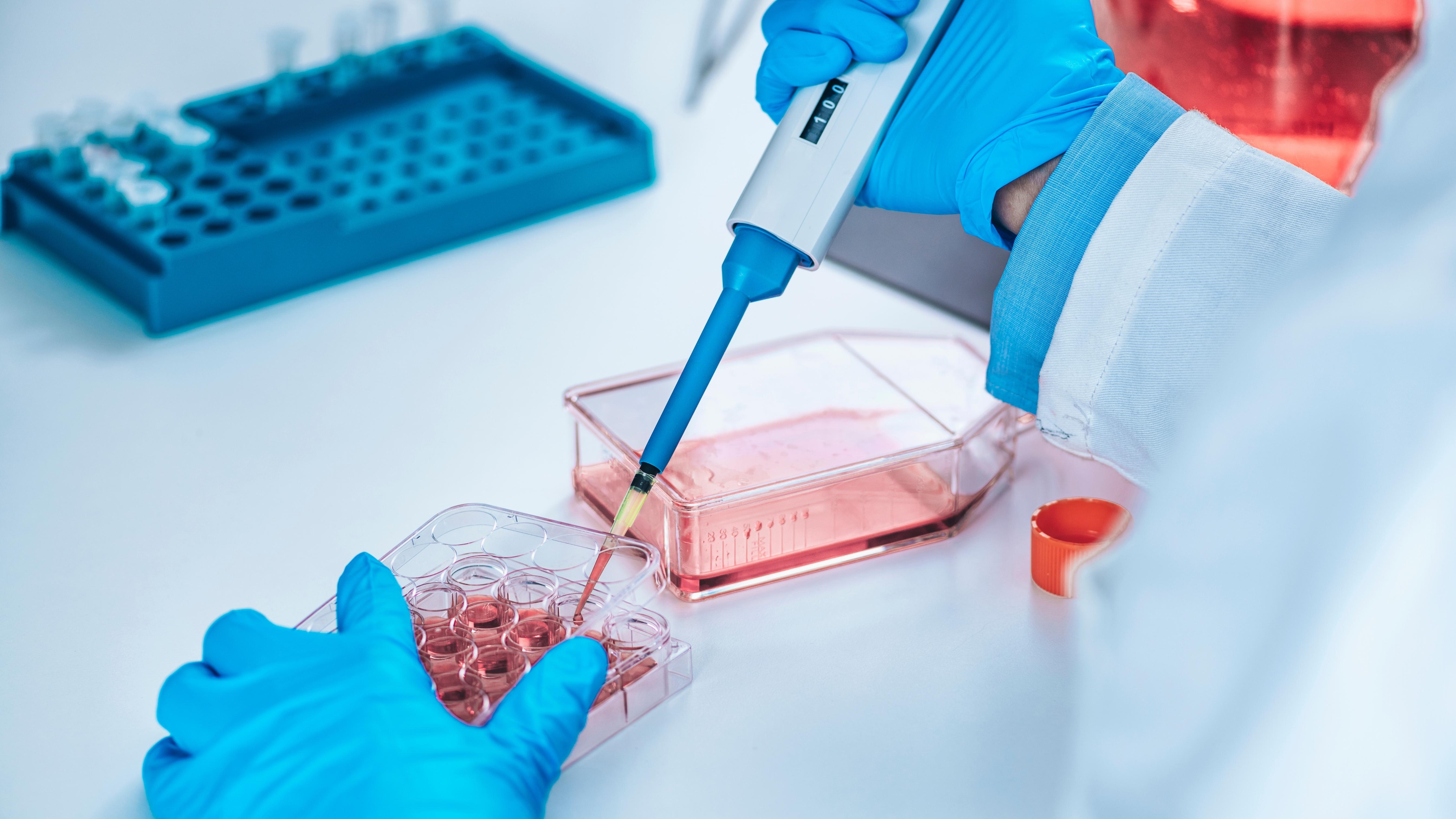 Human carcinoma tumor cells microscopy